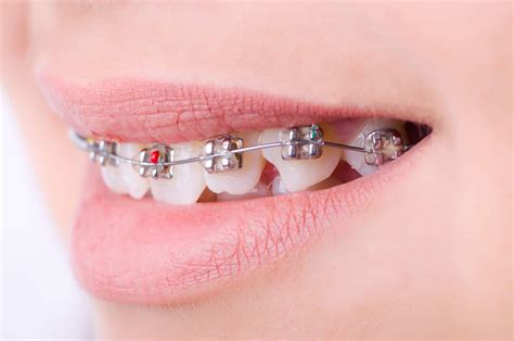 metal en el paladar brackets|para que sirven brackets.